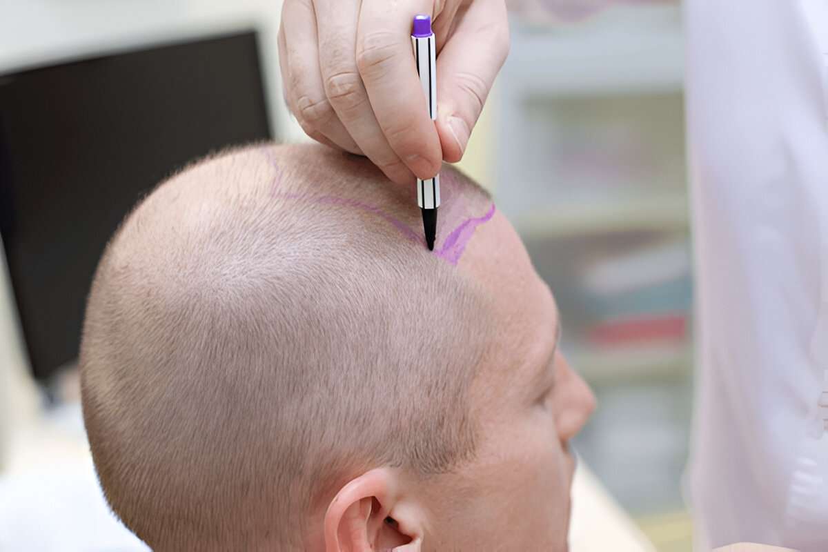 best hair transplant London