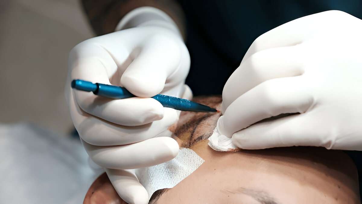 hair transplant