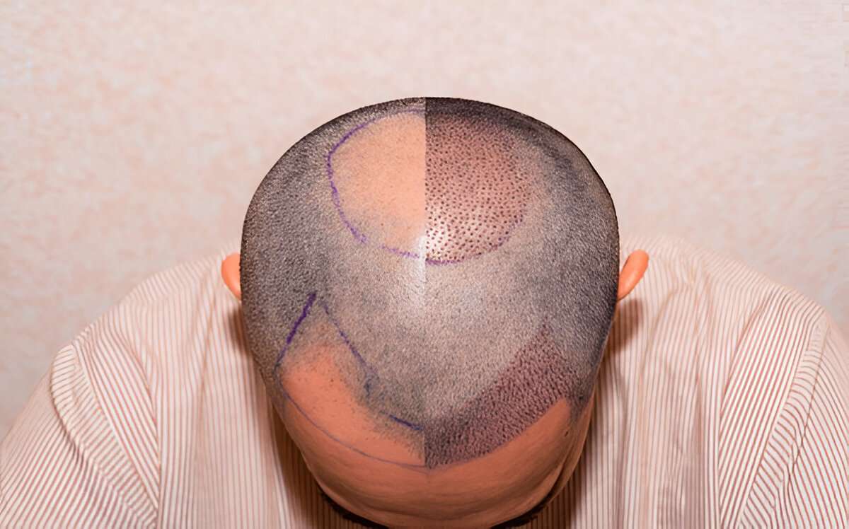 Hair Transplants