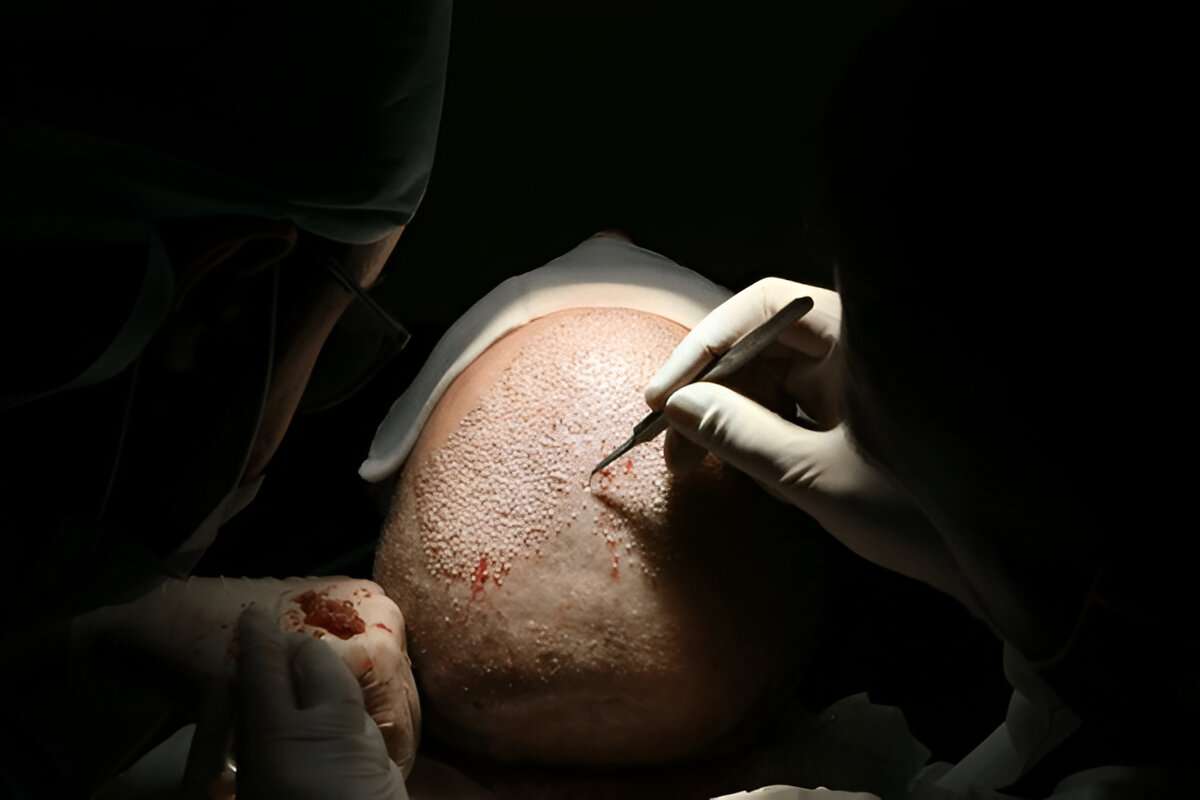 Hair Transplant