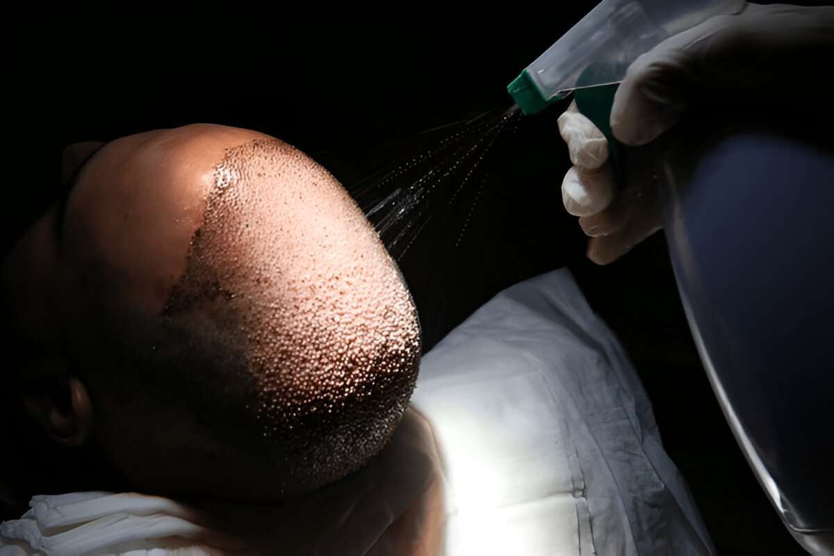 London hair transplant