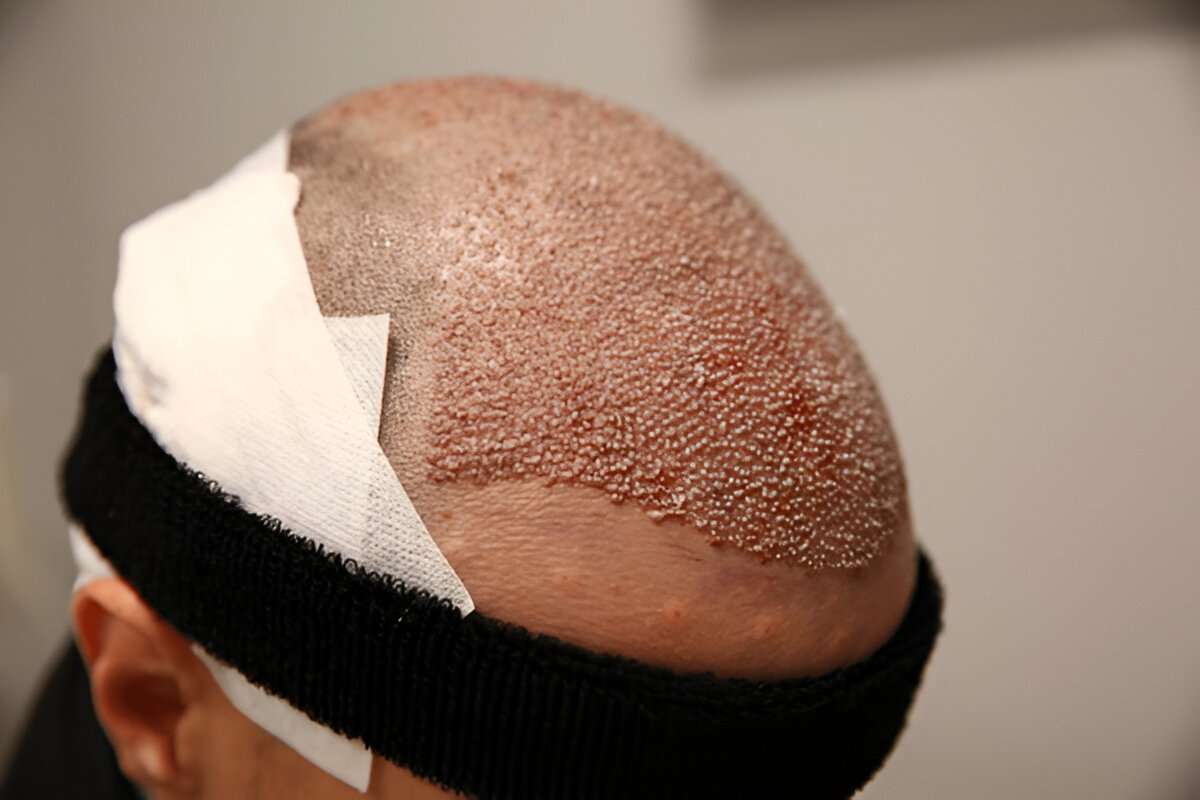 manual hair transplant London