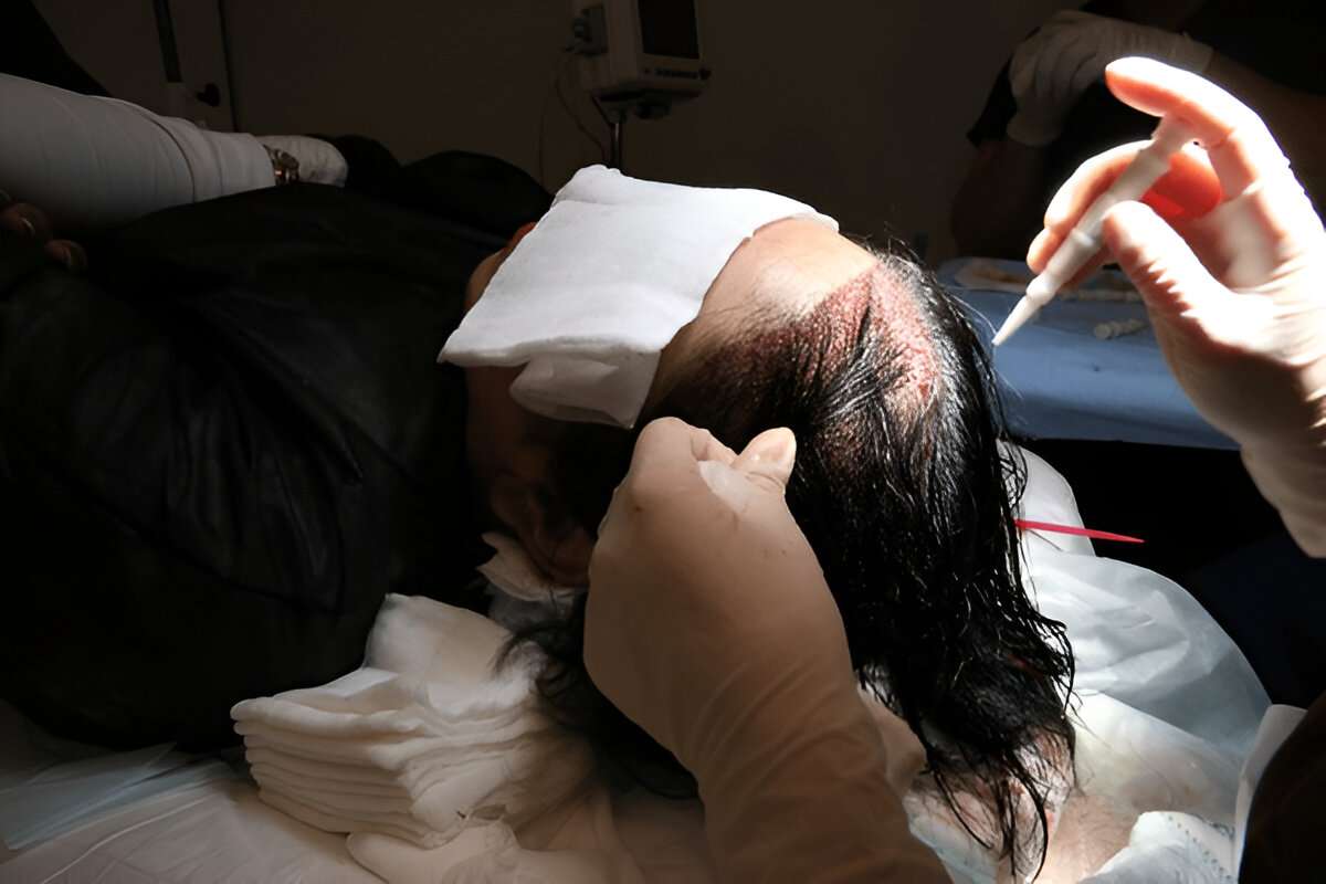 Hair Transplant