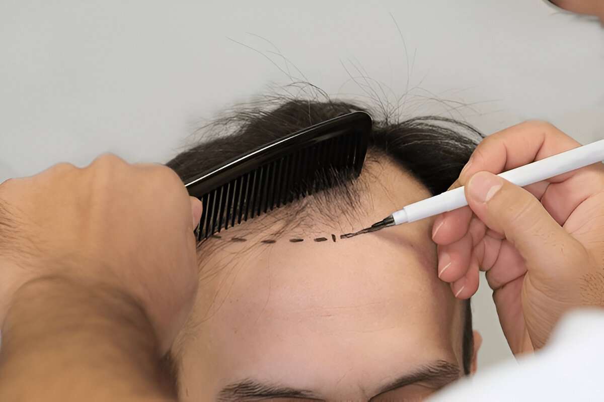 Is a Hair Transplant Worth the Cost