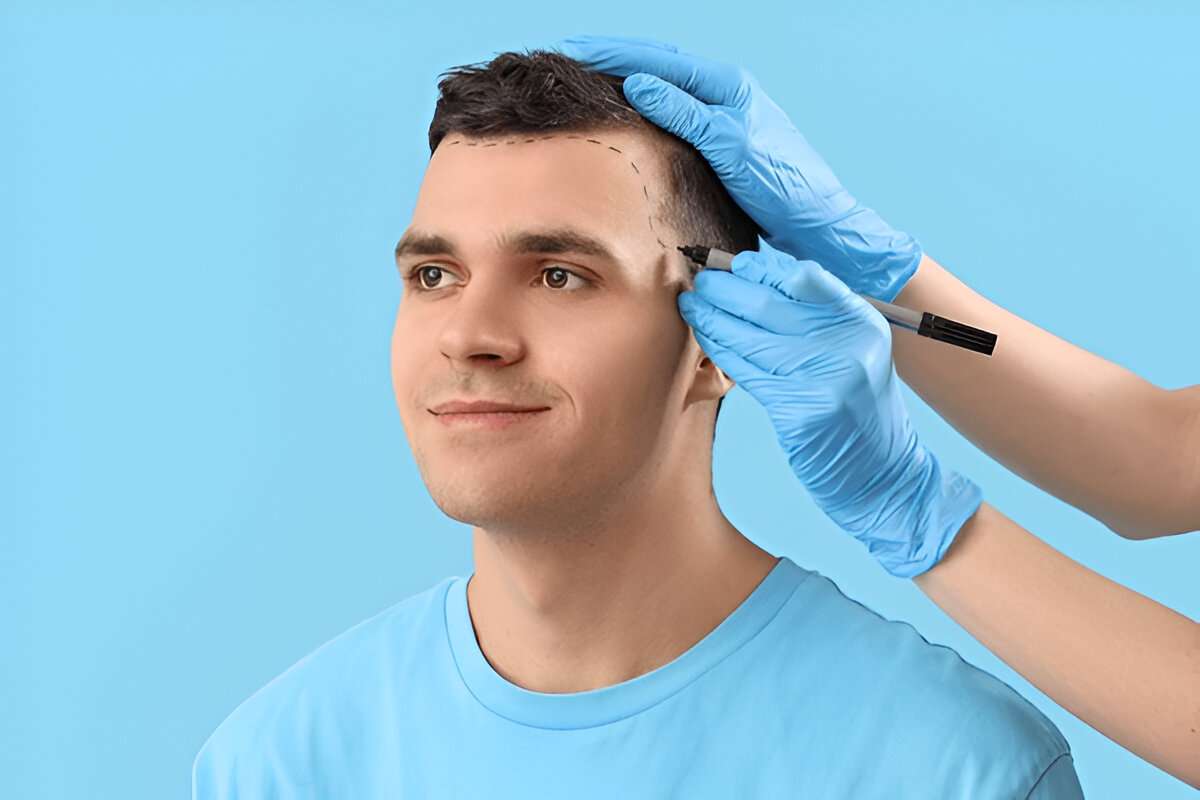 How Do Hair Transplants Improve Confidence