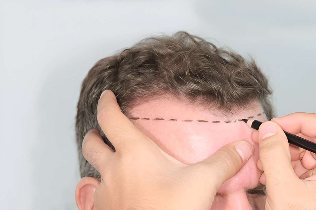 How Much Does a Hair Transplant Cost in the UK