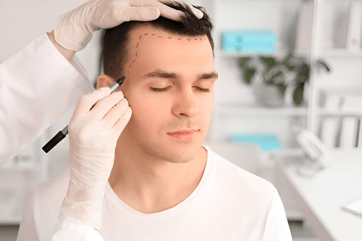 How to Minimise Pain During and After a Hair Transplant