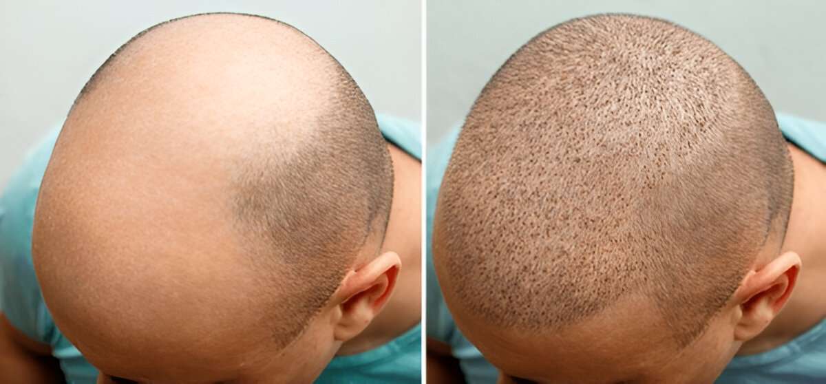 The Psychological Benefits of Getting a Hair Transplant