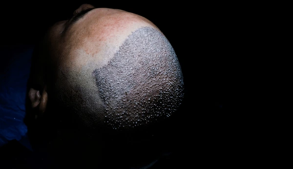 Hair Transplants