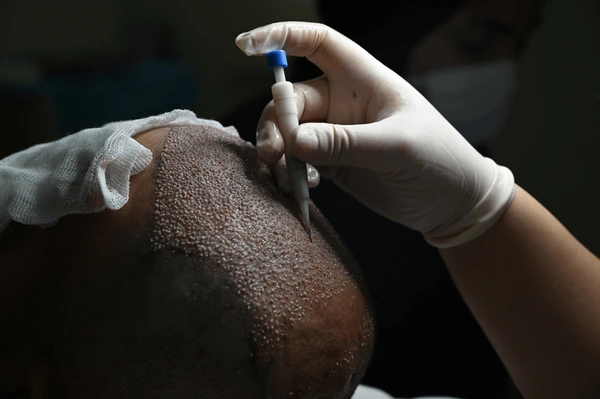 seborrhoeic Dermatitis
