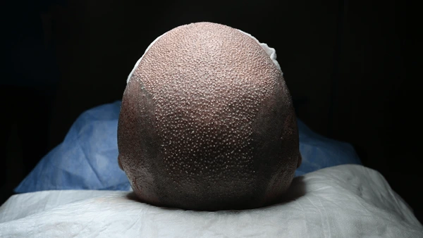 Honest Facts About Hair Loss Treatment