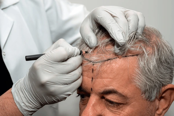hairloss treatment