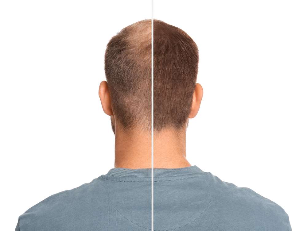 scalp Pigmentation