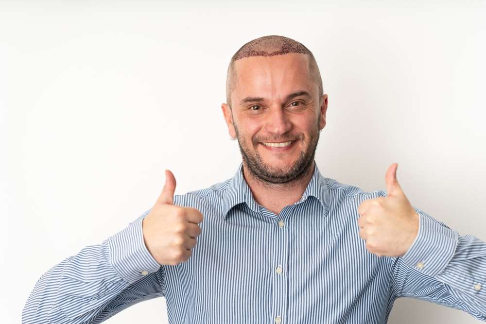 receding hairline