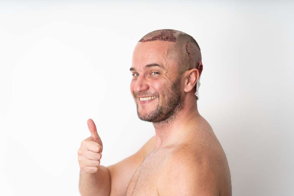 oral minoxidil before and after