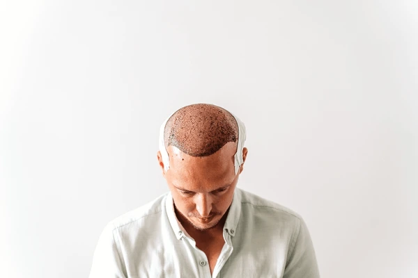 finasteride results